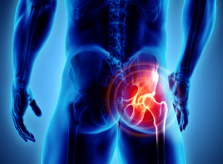 3D illustration, hip painful skeleton x-ray, medical concept.の写真素材