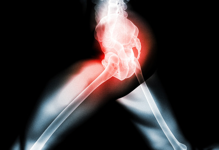 3D illustration, hip painful skeleton x-ray, medical concept.