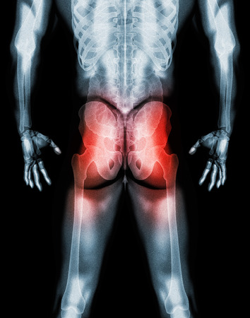 3D illustration, hip painful skeleton x-ray, medical concept.の写真素材
