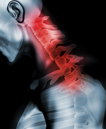 3D illustration, neck painful - cervical spine skeleton x-ray, medical concept.