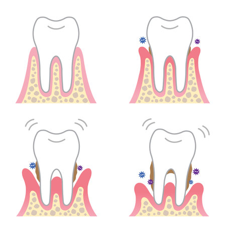 periodontal deseaseのイラスト素材