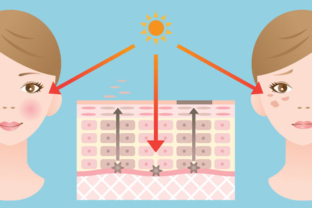 Diagram of skin spots showing when the turnover is disrupted, it will accumulate and pigment the skin. This cause blotches and freckles.のイラスト素材