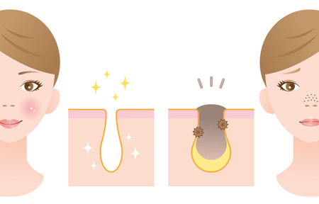 Clogged pores and clean pores on nose.のイラスト素材