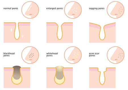 set of skin pores on nose: normal, sagging, enlarged, blackhead, whitehead  and acne scar. beauty and skin care conceptのイラスト素材