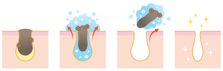 Forming cleanser gently get rid of blackhead. before and after skin care treatmentのイラスト素材