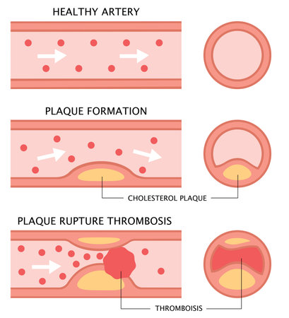 diagram showing stages of atherosclerosis in flat illustration. normal artery, accumulation of cholesterol in blood vessel, and blood clot formationのイラスト素材