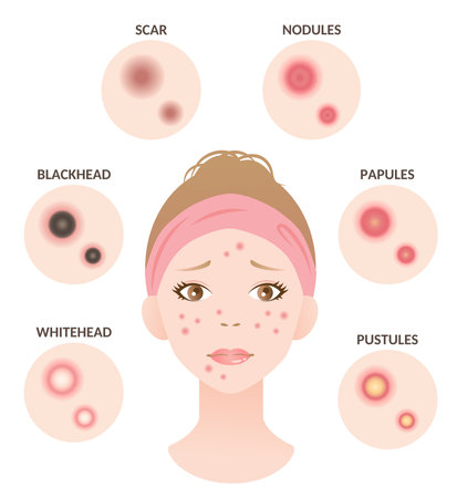 Types of acne pimples and female face. Open comedones, closed comedones, inflammatory acne, cystic acne. Healthy skin care conceptのイラスト素材