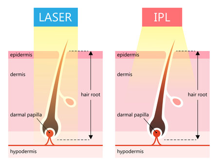 Laser and IPL hair removal illustration. Hair skin structure. Isolated on white backgroundのイラスト素材