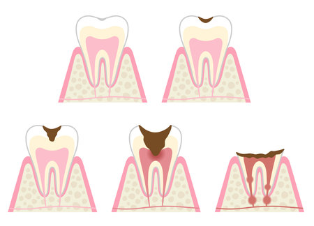 Stages of Tooth Decay illustration. Dental and oral health care concept.のイラスト素材