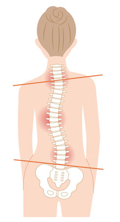 scoliosis woman spine illustration. Health care and medical conceptのイラスト素材