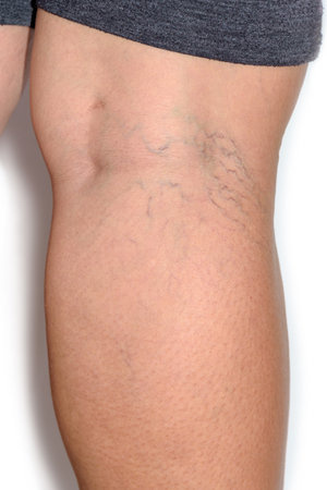 Close up varicose spider vein on skin crook leg elderly woman, Problem thrombosis that can cause blood vessel to clot, Vascular and venous diseases, Health care before the doctor on white backgroundの写真素材