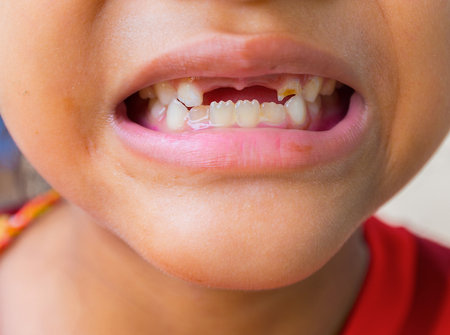 Vulnerability from tooth loss and Unattractive teeth of childrenの写真素材