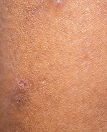 Skin with allergies Inflammation is to blame the scar.