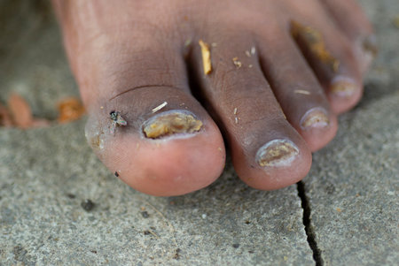Healthy toenail with mold problemsの写真素材