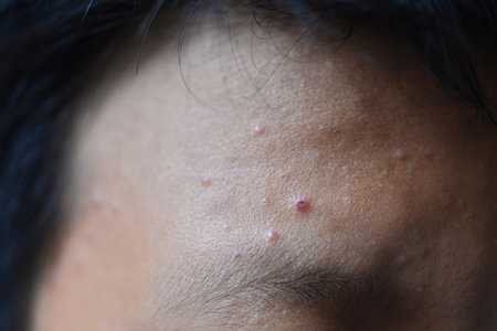 Acne blister tablets that are inflamed on the skin.の写真素材