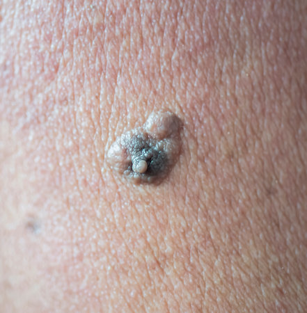 Area blisters that occur on the skin.