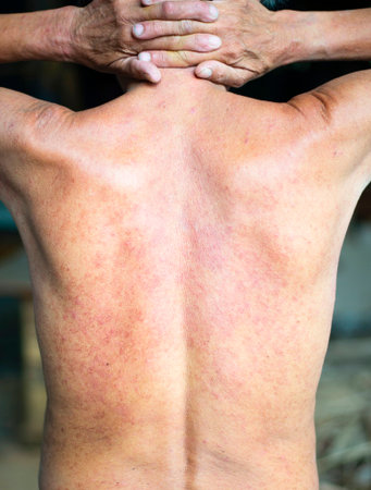 The skin is red and itchy due to allergies of the elderlyの写真素材