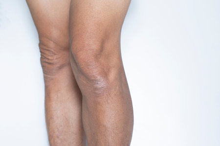 lesion, dermatitis, dark spots of the skin on the legsの写真素材