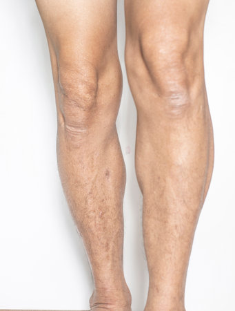 Leg and knee joints of the elderly with muscle and bone degeneration lesion, dermatitis, dark spots of the skin on the legs on a white backdropの写真素材