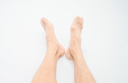 foot dermatitis in elderly people