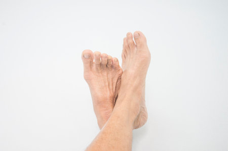 foot dermatitis in elderly peopleの写真素材