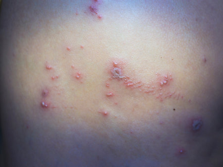 blisters and inflammatory lesions on the skin on a person's bodyの写真素材
