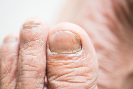 Dry, rough toes and fungal toenails of older peopleの写真素材