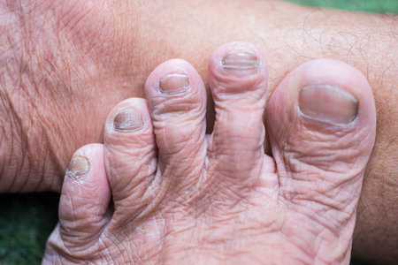 Toe nails that are dry, brittle and have fungus.の写真素材