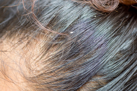 Dandruff, flaky scalp caused by dry skin. Allergy to cosmetics or has fungusの写真素材