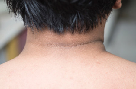 Black stains and wrinkles on the skin around a person's neckの写真素材