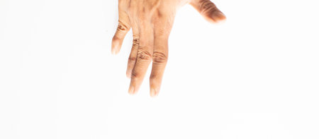 Hand and finger with rough and dry skin.