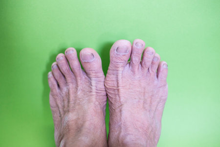 Wrinkles and dryness of the skin of the feet and other parts of the body of an elderly man