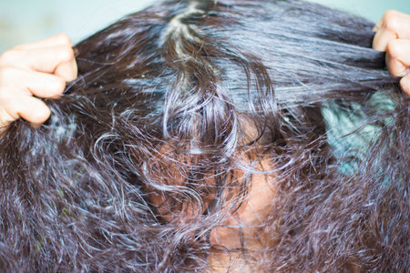 Dandruff and fungus on the scalp cause itching.