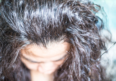 Dandruff and fungus on the scalp cause itching.の写真素材