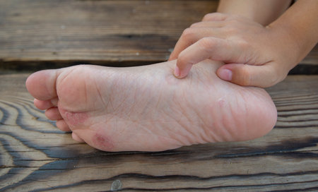 Fungal lesions on children's feetの写真素材