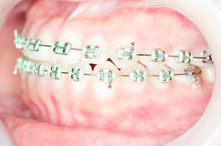Close-up Orthodontic braces with o-ringの写真素材