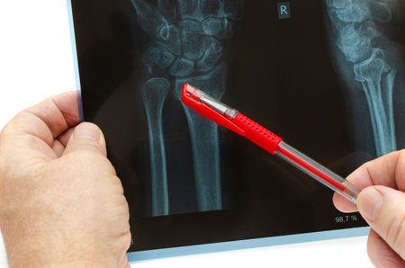 Wrist x-ray, accident, medical image concept.の写真素材
