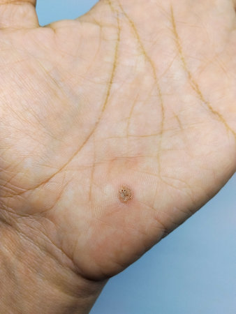 warts on the palm of a man's hand