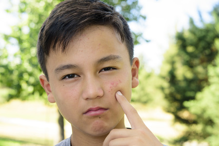 a boy is upset his face pimple pointing pimples, face close upの写真素材
