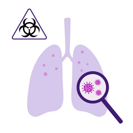 Human lungs infected with coronavirus. Dangerous viral disease causing pneumonia. Vector illustration isolated on white background.のイラスト素材
