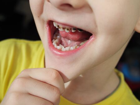 Abnormal boy tooth. The extra narrow strange tooth grew in the boy's mouth. Boy shows his crooked tooth. Patient Orthodontist. Children's teeth problems.の写真素材