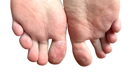 Close up of teenager's feet with peeling skin on toes on white background.の写真素材