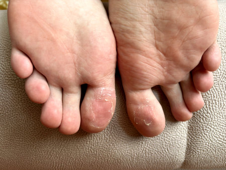 Close-up of feet with peeling skin on the toes and solesの写真素材