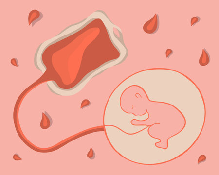 Vector isolated illustration of umbilical cord blood. Stem cells. Freezing stem cells. Collection of umbilical cord blood.のイラスト素材