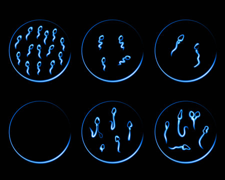 Vector isolated illustration of sperm pathologies. Spermogram. Sperm defects. Defects of the sperm...