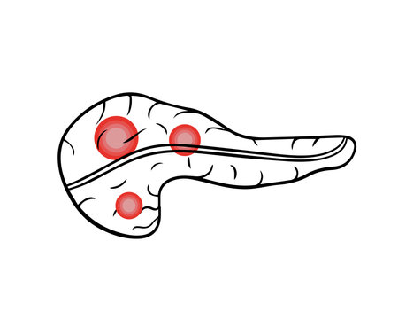 Vector isolated illustration of pancrea.Pancreatic pain. Pancreatic cancer.のイラスト素材