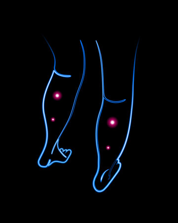 Varicose veins of the legs. Treatment of varicose veins.のイラスト素材