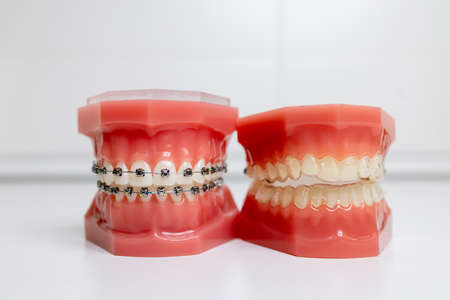 mouth guard and models of teeth with braces on teeth on a jawの写真素材