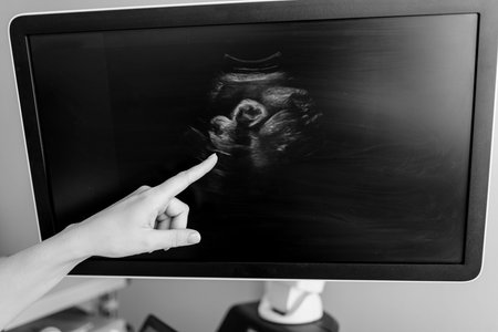 Black and white close up of gynecologist hand pointing at ultrasound screen showing unborn baby...