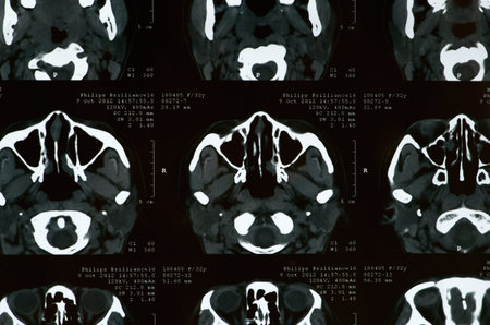x-ray film of the brain computed tomography